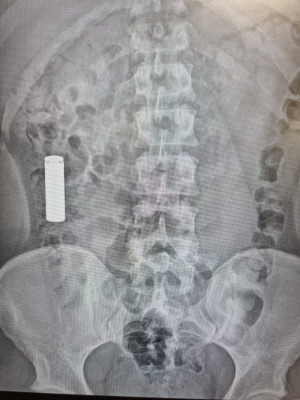 radiografía pila.jpg